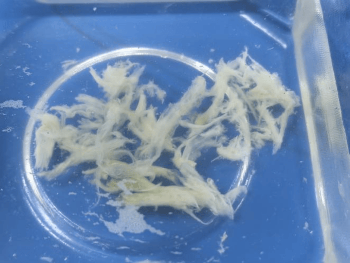 皇冠信用网正版_发热一天就病危皇冠信用网正版！11岁男孩肺里长出“死亡树杈”